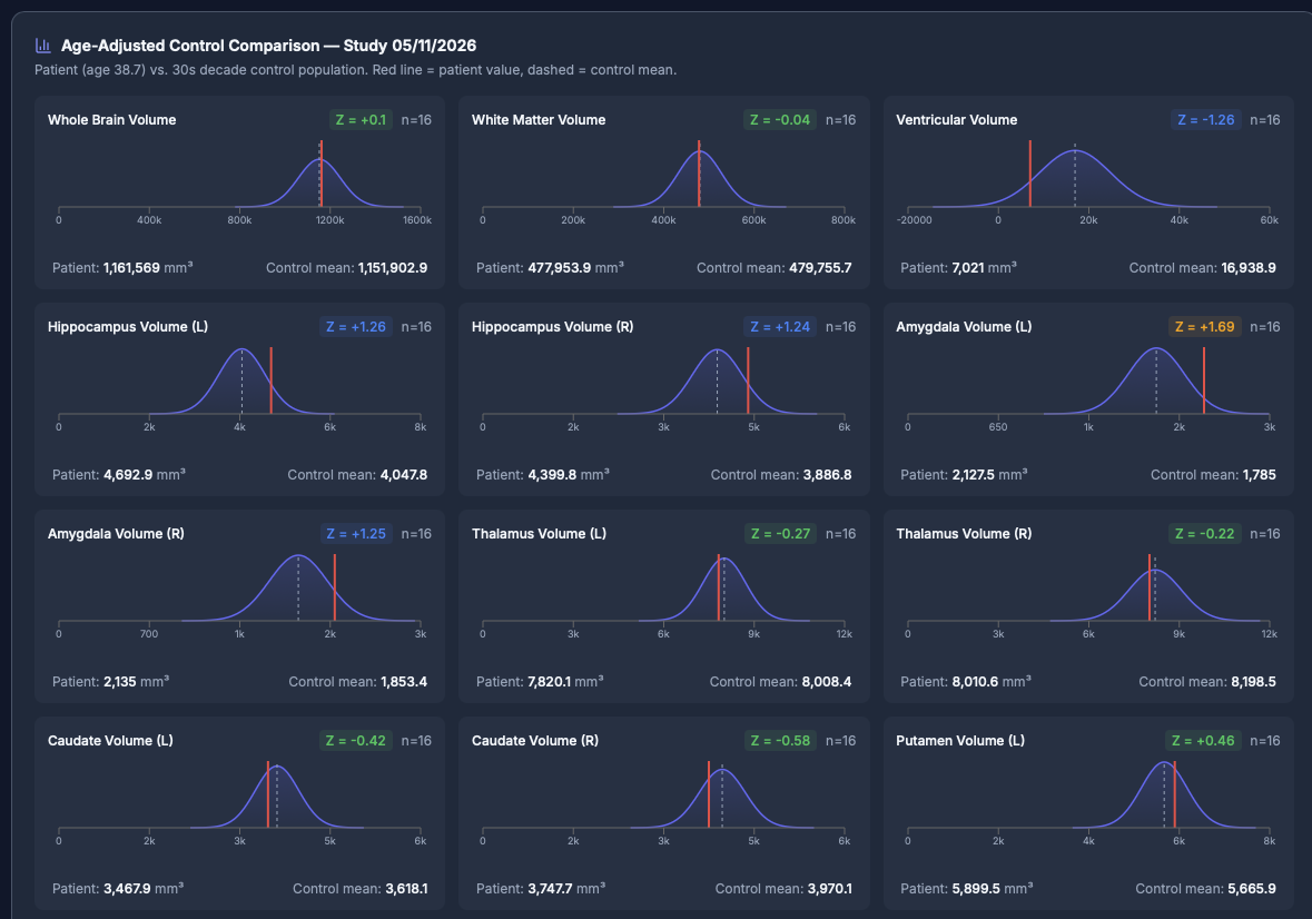 Age-adjusted control comparison panel showing Gaussian distributions for each structure with patient value and control mean.