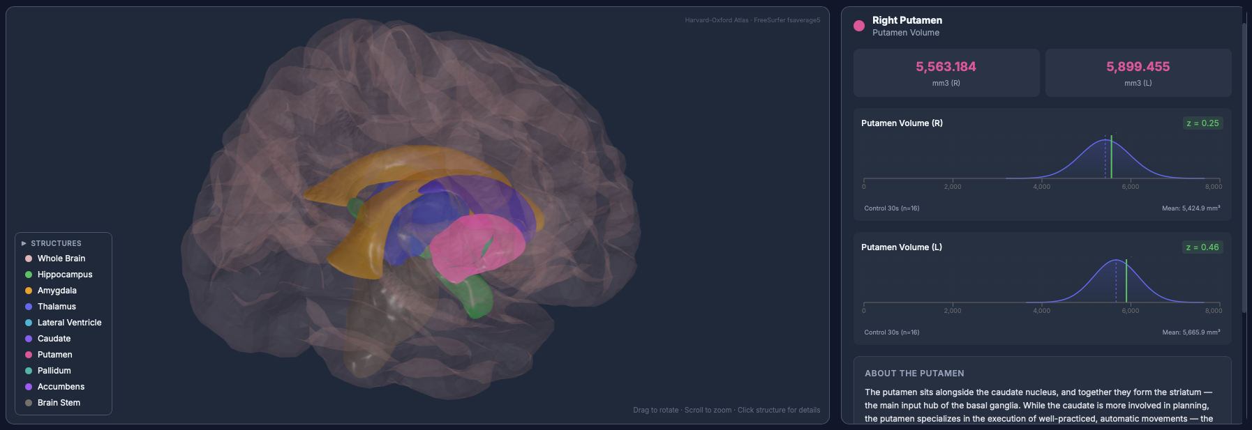 Interactive 3D brain visualization showing segmented Harvard-Oxford subcortical structures with Right Putamen highlighted, volume metrics, and z-score distribution against age-matched controls.